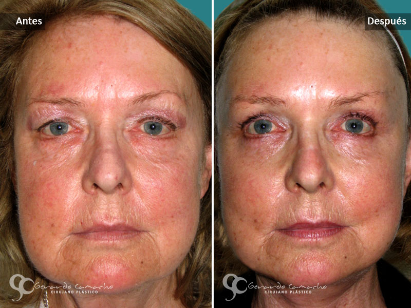 Rejuvenecimiento Facial  Quirúrgico o Ritidoplastia o Lifting Facial o Estiramiento Facial